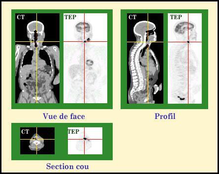 Diagnostics TEP : tomographies par émission de positons
